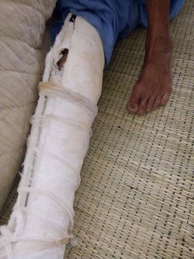 Kinh hoàng bố bị con trai đánh bầm dập, gãy xương sườn, mẻ bánh chè